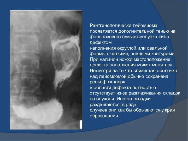 Рентгенологически лейомиома проявляется дополнительной тенью на фоне газового пузыря желудка