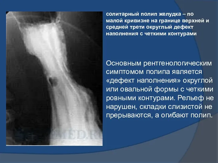 Основным рентгенологическим симптомом полипа является «дефект наполнения» округлой или овальной