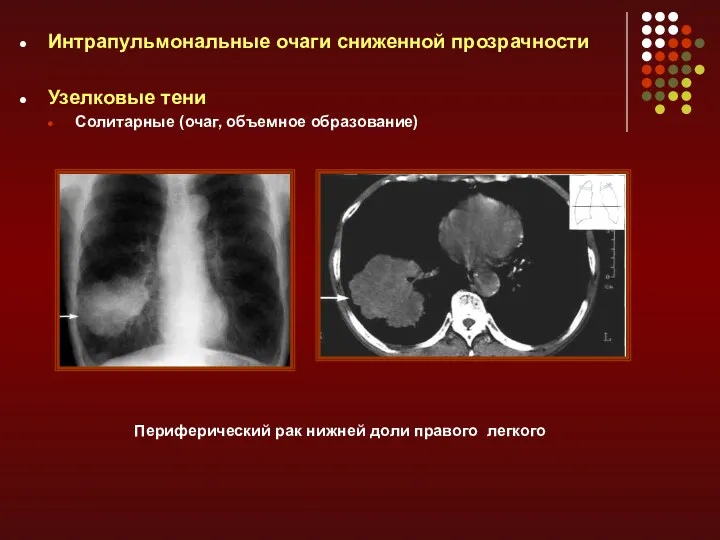 Интрапульмональные очаги сниженной прозрачности Узелковые тени Солитарные (очаг, объемное образование) Периферический рак нижней доли правого легкого