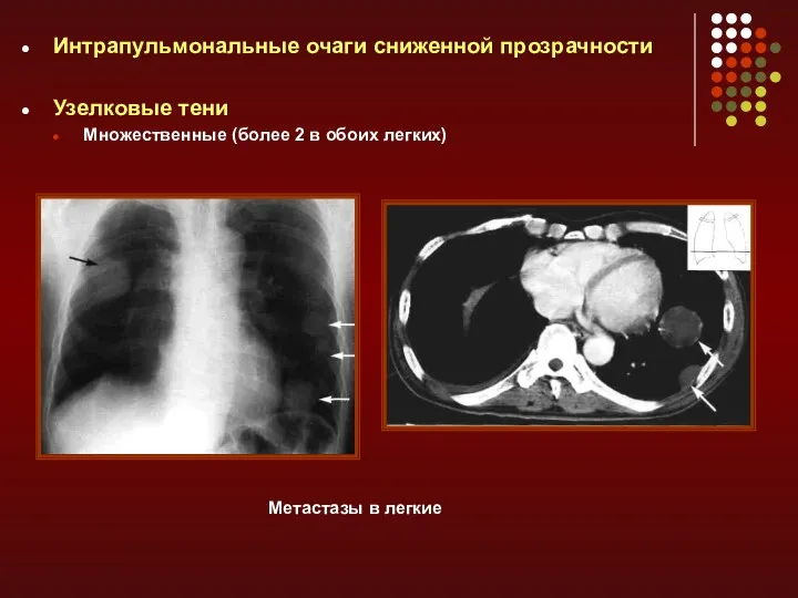 Интрапульмональные очаги сниженной прозрачности Узелковые тени Множественные (более 2 в обоих легких) Метастазы в легкие