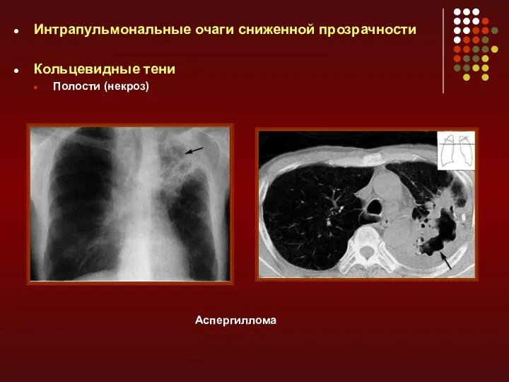 Интрапульмональные очаги сниженной прозрачности Кольцевидные тени Полости (некроз) Аспергиллома