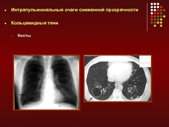 Интрапульмональные очаги сниженной прозрачности Кольцевидные тени Кисты