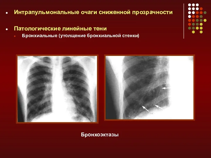 Интрапульмональные очаги сниженной прозрачности Патологические линейные тени Бронхиальные (утолщение бронхиальной стенки) Бронхоэктазы