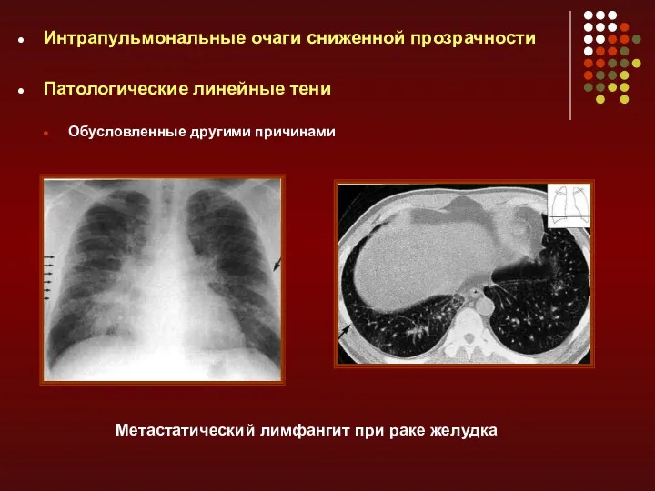 Интрапульмональные очаги сниженной прозрачности Патологические линейные тени Обусловленные другими причинами Метастатический лимфангит при раке желудка