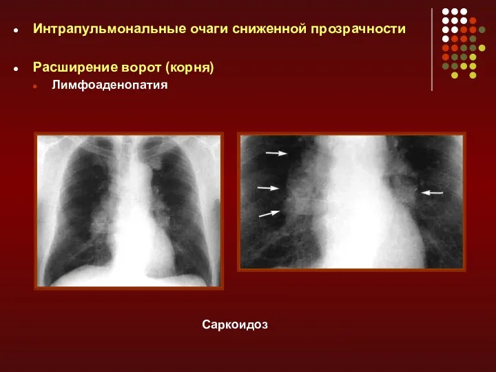 Интрапульмональные очаги сниженной прозрачности Расширение ворот (корня) Лимфоаденопатия Саркоидоз