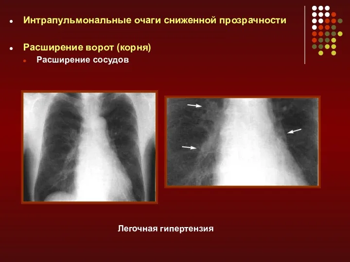 Интрапульмональные очаги сниженной прозрачности Расширение ворот (корня) Расширение сосудов Легочная гипертензия