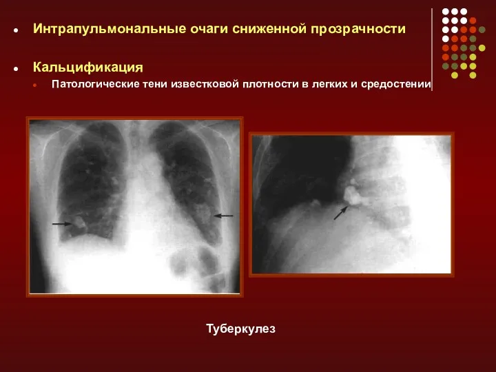 Интрапульмональные очаги сниженной прозрачности Кальцификация Патологические тени известковой плотности в легких и средостении Туберкулез