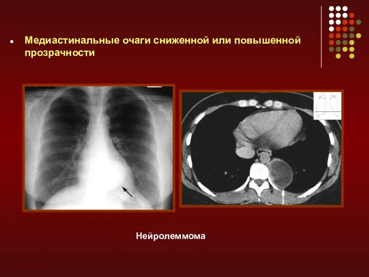 Медиастинальные очаги сниженной или повышенной прозрачности Нейролеммома