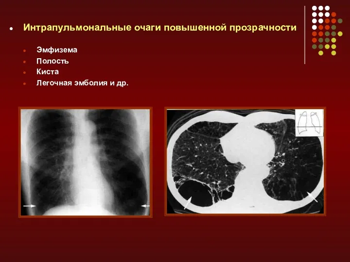 Интрапульмональные очаги повышенной прозрачности Эмфизема Полость Киста Легочная эмболия и др.