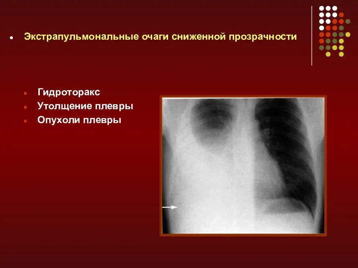 Экстрапульмональные очаги сниженной прозрачности Гидроторакс Утолщение плевры Опухоли плевры