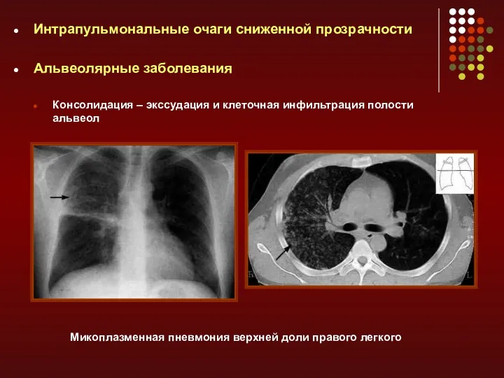 Интрапульмональные очаги сниженной прозрачности Альвеолярные заболевания Консолидация – экссудация и