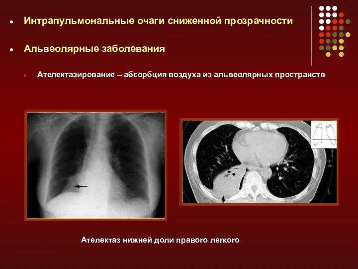 Интрапульмональные очаги сниженной прозрачности Альвеолярные заболевания Ателектазирование – абсорбция воздуха