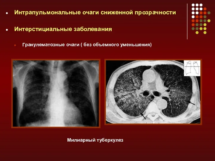 Интрапульмональные очаги сниженной прозрачности Интерстициальные заболевания Гранулематозные очаги ( без объемного уменьшения) Милиарный туберкулез