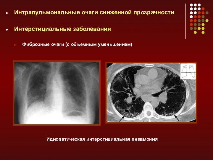 Интрапульмональные очаги сниженной прозрачности Интерстициальные заболевания Фиброзные очаги (с объемным уменьшением) Идиопатическая интерстициальная пневмония