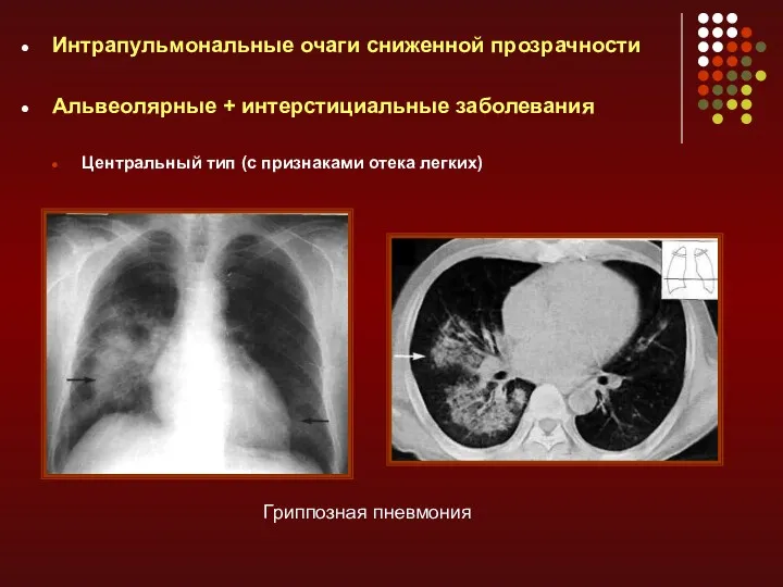 Интрапульмональные очаги сниженной прозрачности Альвеолярные + интерстициальные заболевания Центральный тип (с признаками отека легких) Гриппозная пневмония