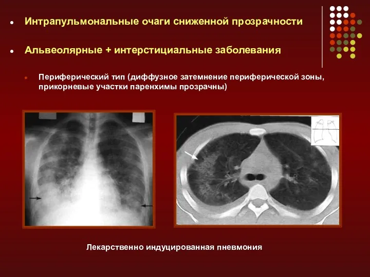 Интрапульмональные очаги сниженной прозрачности Альвеолярные + интерстициальные заболевания Периферический тип