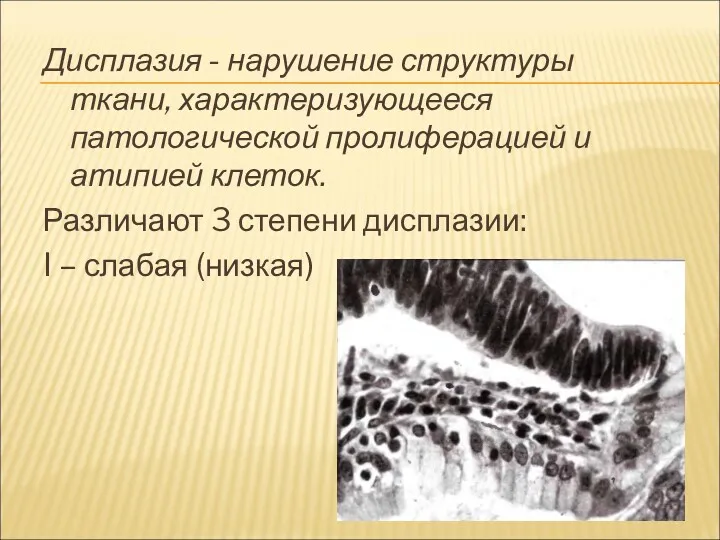 Дисплазия - нарушение структуры ткани, характеризующееся патологической пролиферацией и атипией