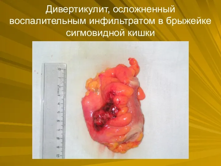 Дивертикулит, осложненный воспалительным инфильтратом в брыжейке сигмовидной кишки