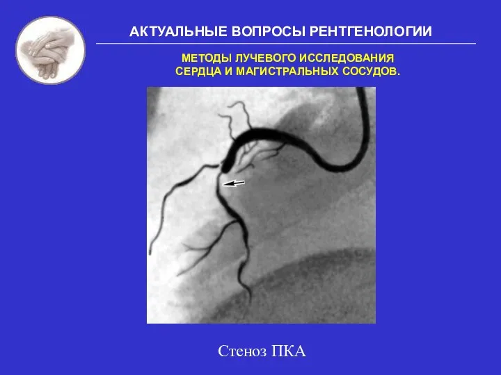 АКТУАЛЬНЫЕ ВОПРОСЫ РЕНТГЕНОЛОГИИ МЕТОДЫ ЛУЧЕВОГО ИССЛЕДОВАНИЯ СЕРДЦА И МАГИСТРАЛЬНЫХ СОСУДОВ. Стеноз ПКА