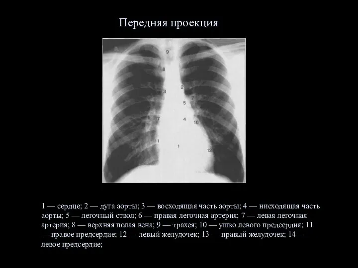 Передняя проекция 1 — сердце; 2 — дуга аорты; 3