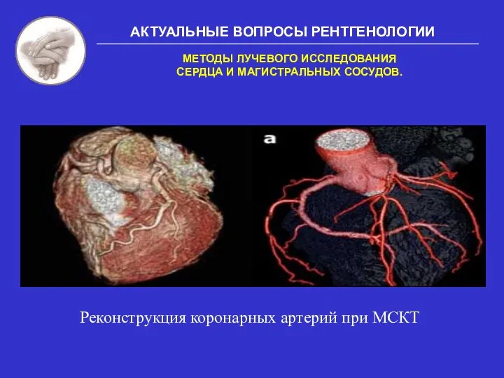 АКТУАЛЬНЫЕ ВОПРОСЫ РЕНТГЕНОЛОГИИ МЕТОДЫ ЛУЧЕВОГО ИССЛЕДОВАНИЯ СЕРДЦА И МАГИСТРАЛЬНЫХ СОСУДОВ. Реконструкция коронарных артерий при МСКТ