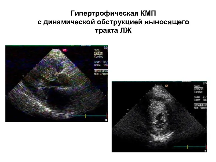 Гипертрофическая КМП с динамической обструкцией выносящего тракта ЛЖ