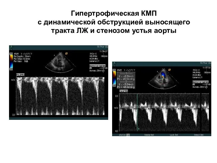 Гипертрофическая КМП с динамической обструкцией выносящего тракта ЛЖ и стенозом устья аорты