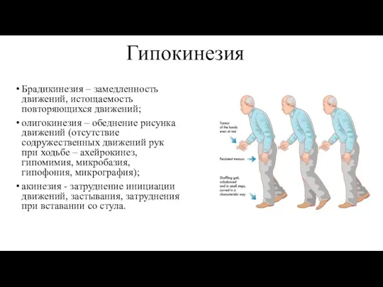 Гипокинезия Брадикинезия – замедленность движений, истощаемость повторяющихся движений; олигокинезия –