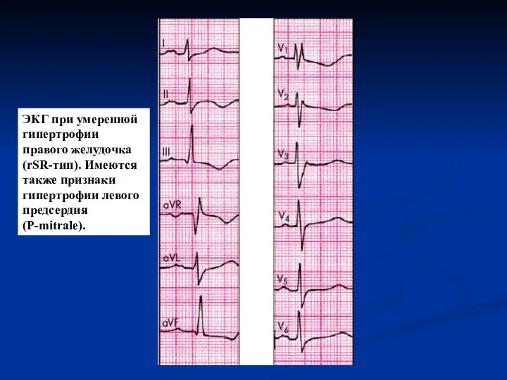 ЭКГ при умеренной гипертрофии правого желудочка (rSR-тип). Имеются также признаки гипертрофии левого предсердия (P-mitrale).