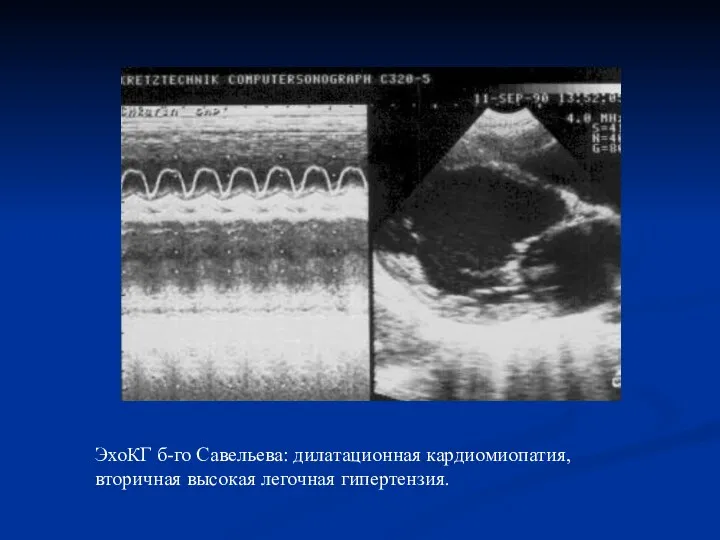 ЭхоКГ б-го Савельева: дилатационная кардиомиопатия, вторичная высокая легочная гипертензия.