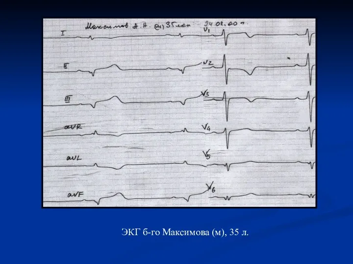 ЭКГ б-го Максимова (м), 35 л.