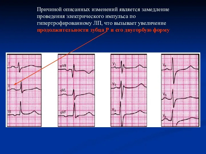 Причиной описанных изменений является замедление проведения электрического импульса по гипертрофированному