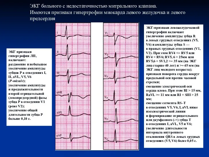 ЭКГ больного с недостаточностью митрального клапана. Имеются признаки гипертрофии миокарда