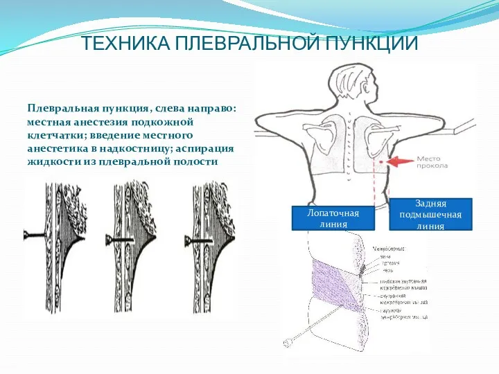 ТЕХНИКА ПЛЕВРАЛЬНОЙ ПУНКЦИИ Плевральная пункция, слева направо: местная анестезия подкожной клетчатки; введение местного