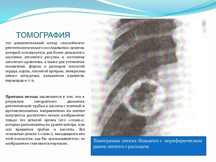 ТОМОГРАФИЯ это дополнительный метод «послойного» рентгенологического исследования органов, который используется для более детального
