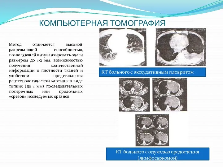 КОМПЬЮТЕРНАЯ ТОМОГРАФИЯ Метод отличается высокой разрешающей способностью, позволяющей визуализировать очаги