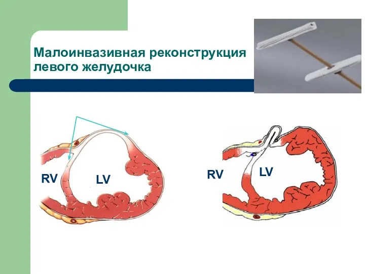 RV LV RV LV Малоинвазивная реконструкция левого желудочка