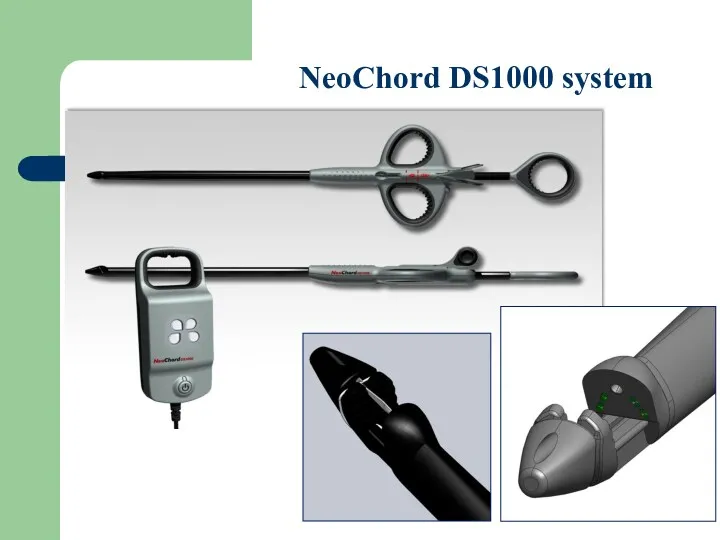 NeoChord DS1000 system