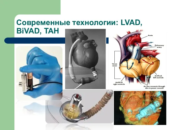 Современные технологии: LVAD, BiVAD, TAH