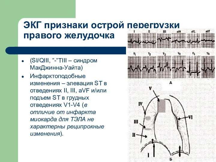 ЭКГ признаки острой перегрузки правого желудочка (SI/QIII, ”-”TIII – синдром