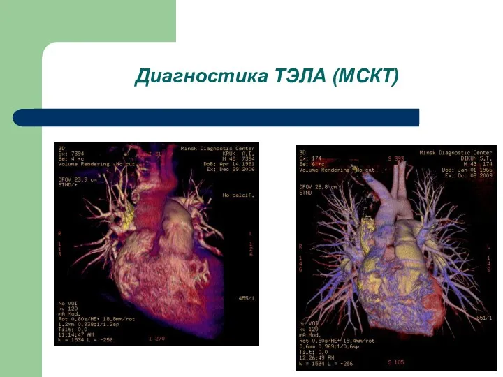 Диагностика ТЭЛА (МСКТ)