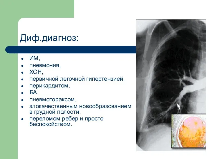 Диф.диагноз: ИМ, пневмония, ХСН, первичной легочной гипертензией, перикардитом, БА, пневмотораксом,