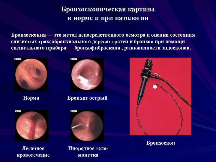 Бронхоскопическая картина в норме и при патологии Норма Бронхит острый