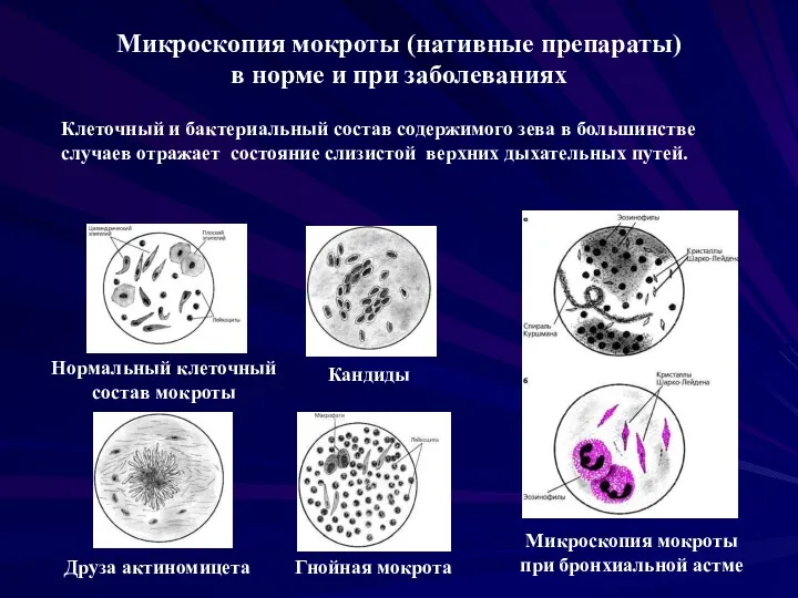 Кандиды Друза актиномицета Гнойная мокрота Нормальный клеточный состав мокроты Микроскопия