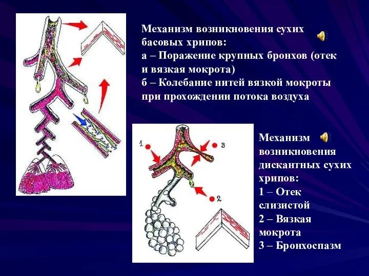 Механизм возникновения сухих басовых хрипов: а – Поражение крупных бронхов