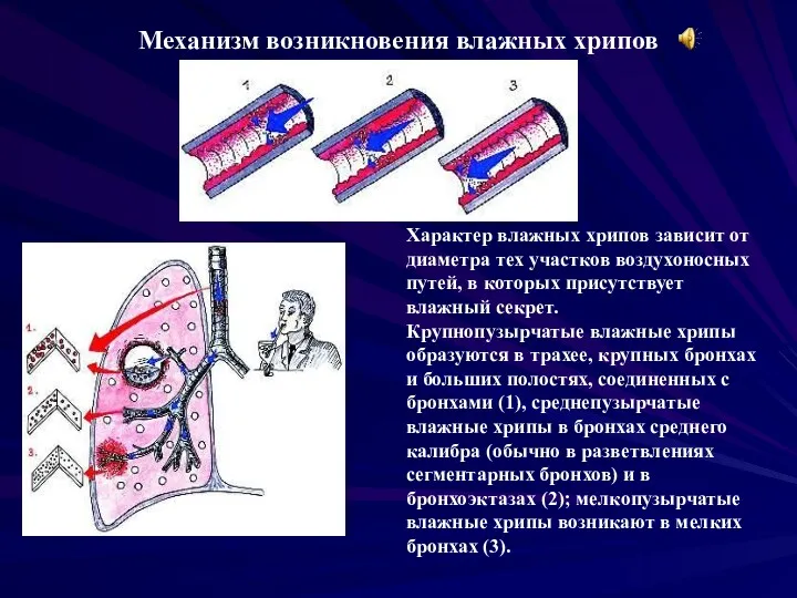 Механизм возникновения влажных хрипов Характер влажных хрипов зависит от диаметра