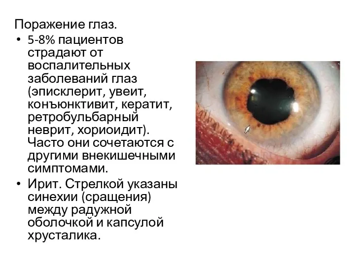 Поражение глаз. 5-8% пациентов страдают от воспалительных заболеваний глаз (эписклерит, увеит, конъюнктивит, кератит,