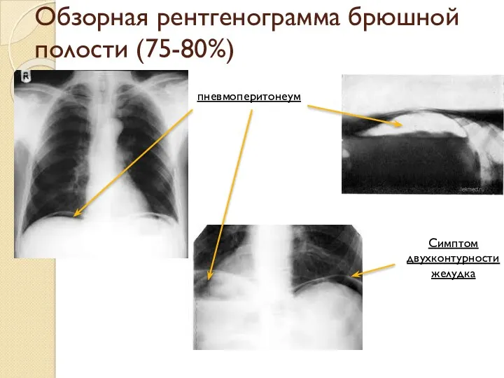 Обзорная рентгенограмма брюшной полости (75-80%) пневмоперитонеум Симптом двухконтурности желудка