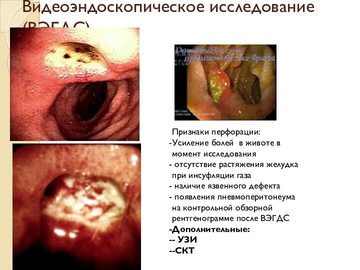 Видеоэндоскопическое исследование (ВЭГДС) Признаки перфорации: Усиление болей в животе в момент исследования отсутствие