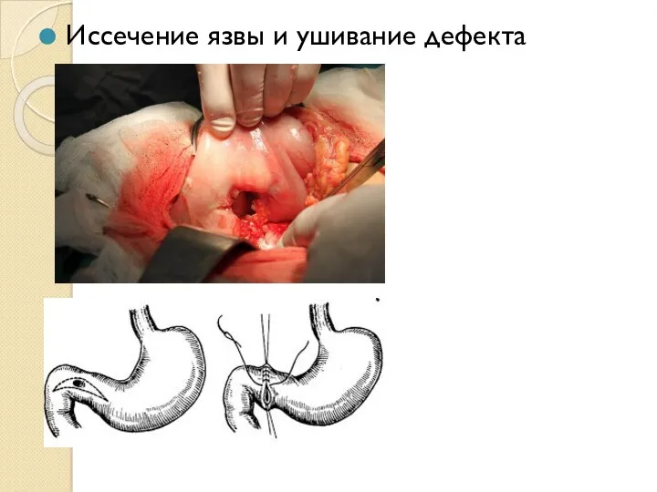 Иссечение язвы и ушивание дефекта